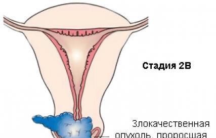 Рак in situ шейки матки. Виды рака шейки матки. Карцинома in situ: лечение и период восстановления