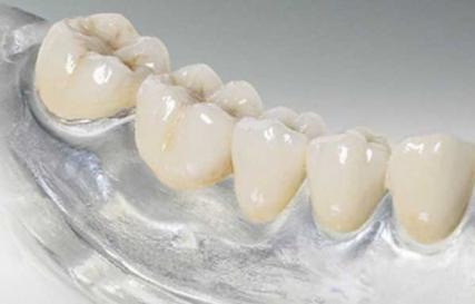 Особенности гибких зубных протезов
