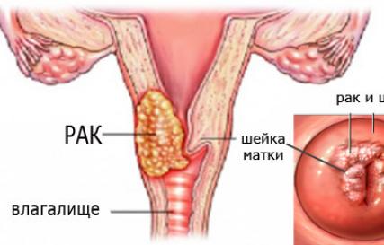 Рак матки и шейки матки: первые признаки и симптомы